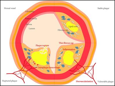 Novel ultrasound techniques in the identification of vulnerable plaques—an updated review of the literature
